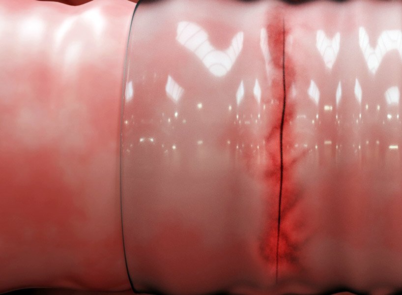 麻省理工学院的工程师开发出用于缝合和手术的外科“管道胶带”