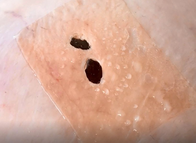 麻省理工学院的工程师开发出用于缝合和手术的外科“管道胶带”