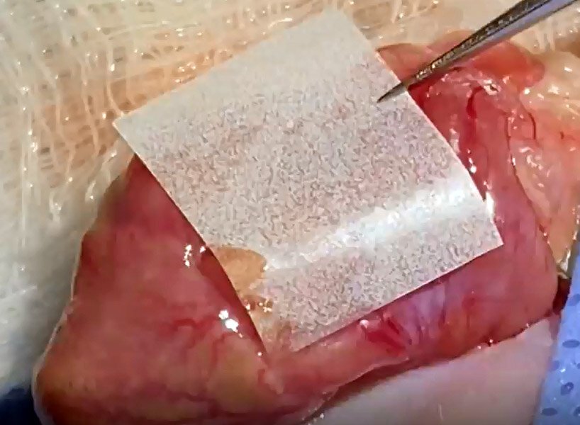 麻省理工学院的工程师开发出用于缝合和手术的外科“管道胶带”