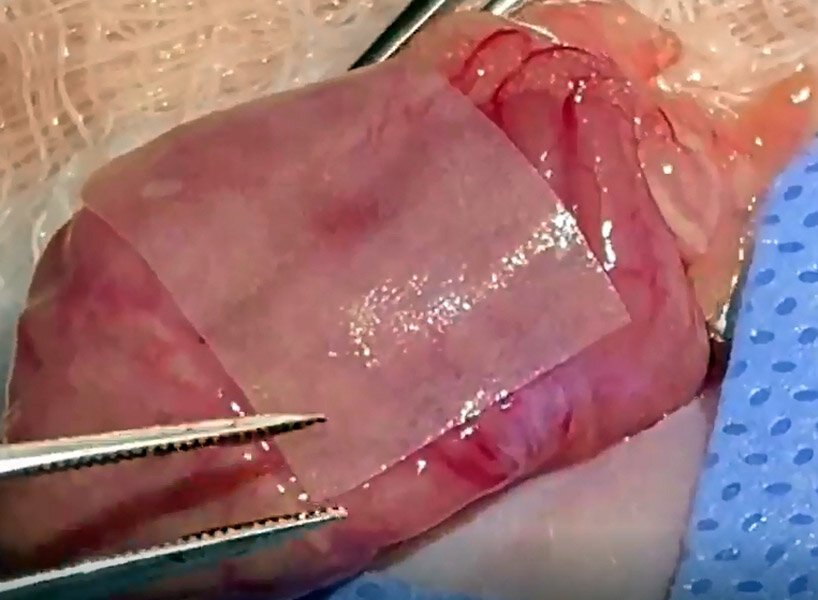 麻省理工学院的工程师开发出用于缝合和手术的外科“管道胶带”